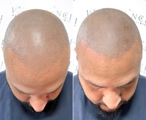 How long does scalp micropigmentation last? Expert insights